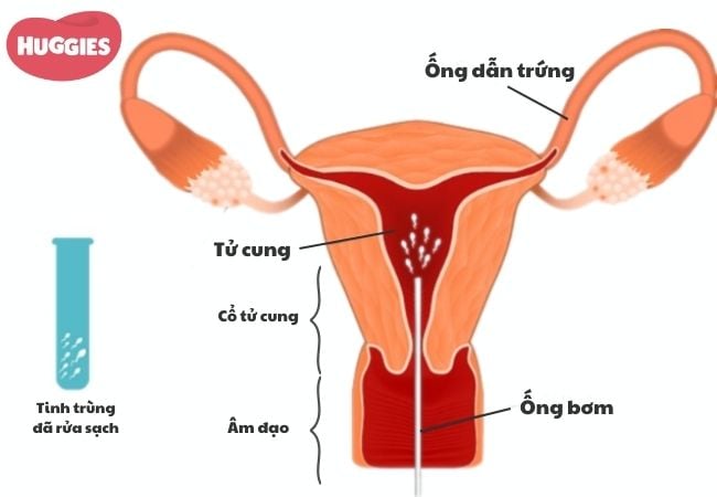 Phương pháp bơm tinh trùng vào tử cung IUI