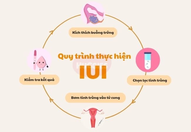 Quy trình thực hiện IUI cơ bản