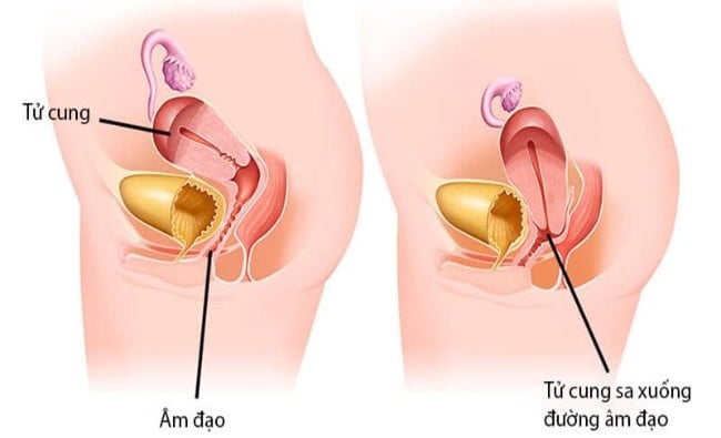 Sa tử cung là tình trạng các cơ và dây chằng hỗ trợ sàn chậu bị kéo căng và suy yếu