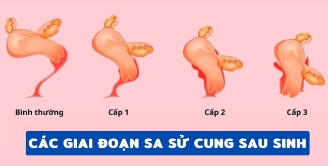 Sa tử cung sau sinh có 4 giai đoạn