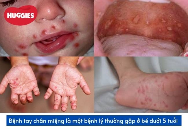 Bé bị tay chân miệng thường gặp ở trẻ dưới 5 tuổi