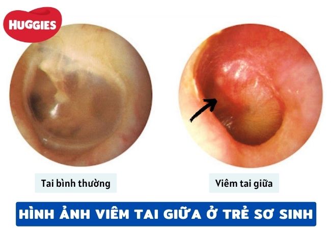 hình ảnh viêm tai giữa ở trẻ sơ sinh