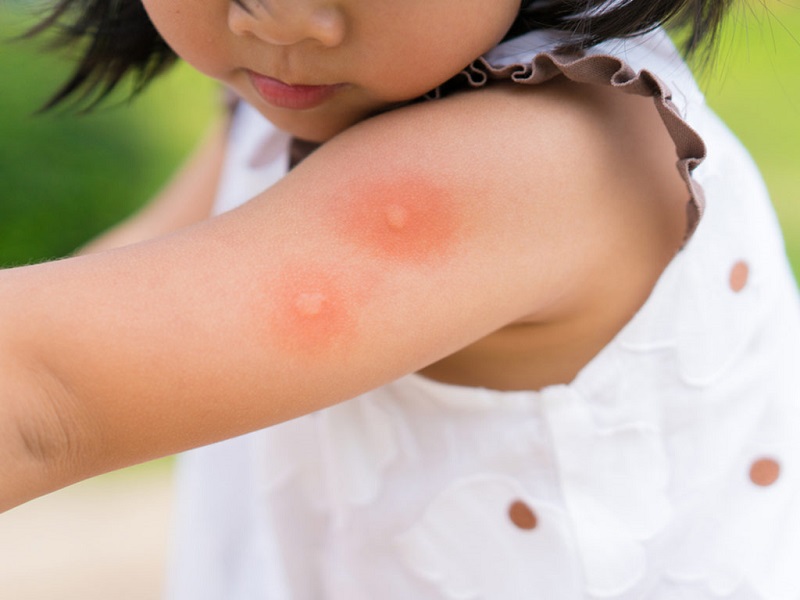 Những triệu chứng sốt xuất huyết ở trẻ em và cách chữa trị