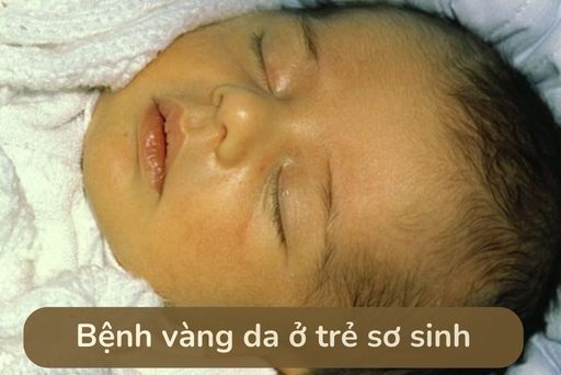 Làm sao để phòng tránh mắc phải vàng da bệnh lý?