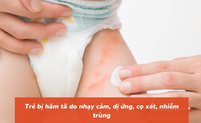 Trẻ bị hăm tã do nhạy cảm, dị ứng