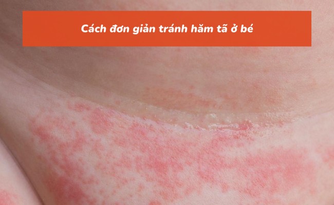 Cách đơn giản tránh hăm tã ở bé