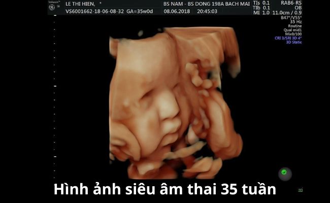 Thai 35 tuần nặng bao nhiêu? Sự phát triển của bé, lưu ý quan ...