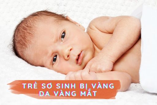 Em Bé Bị Vàng Da Vàng Mắt: Nguyên Nhân và Cách Điều Trị Hiệu Quả