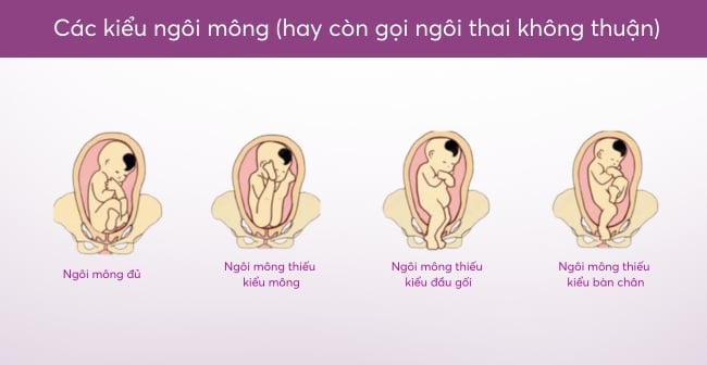 Dự đoán ngôi thai bằng tay