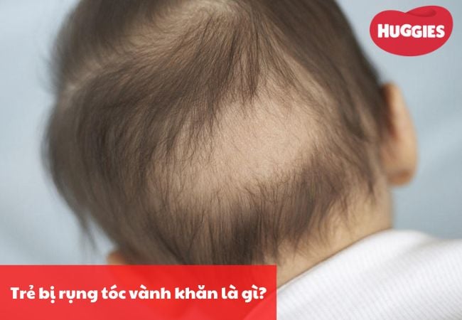 Trẻ bị rụng tóc vành khăn là gì?