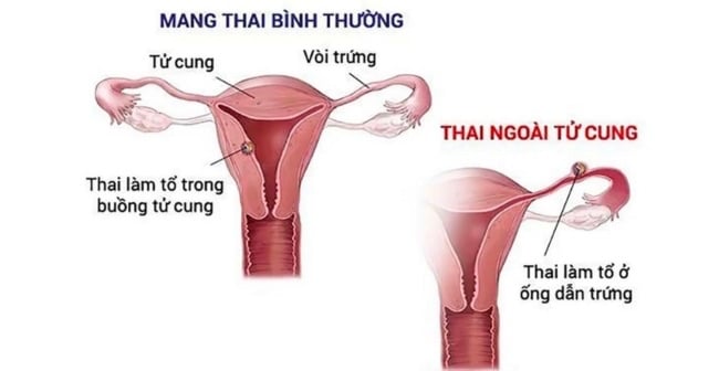 Mang thai ngoài tử cung có nguy hiểm không?