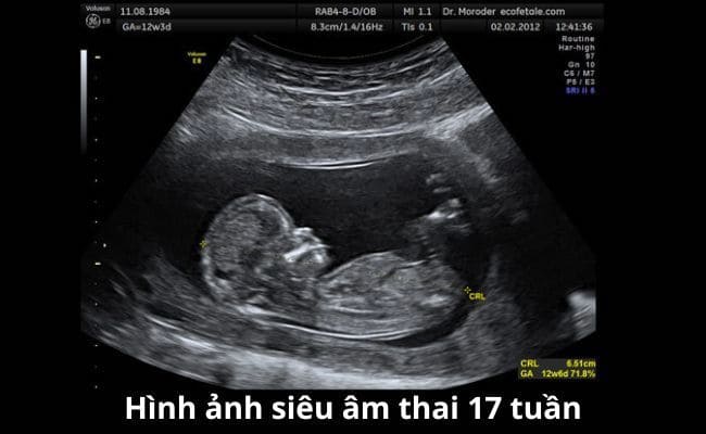 Hình ảnh siêu âm thai 17 tuần (Nguồn: Sưu tầm)