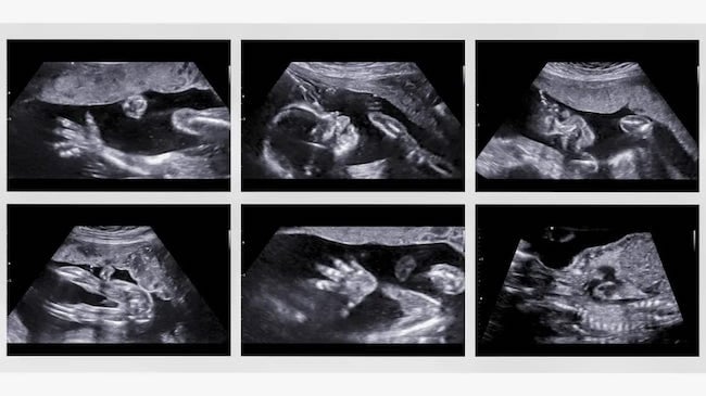 Hình ảnh siêu âm 4D của thai nhi 20 tuần tuổi (Nguồn: Sưu tầm)