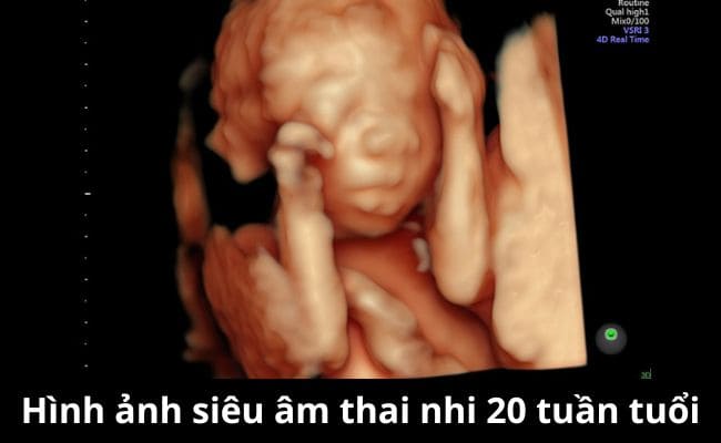 Hình ảnh siêu âm thai nhi 20 tuần (Nguồn: Sưu tầm)