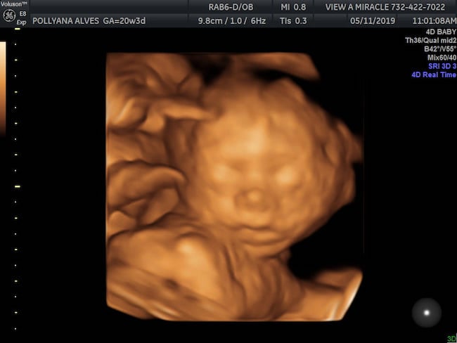 Hình ảnh siêu âm 4D khuôn mặt em bé 20 tuần tuổi (Nguồn: Sưu tầm)