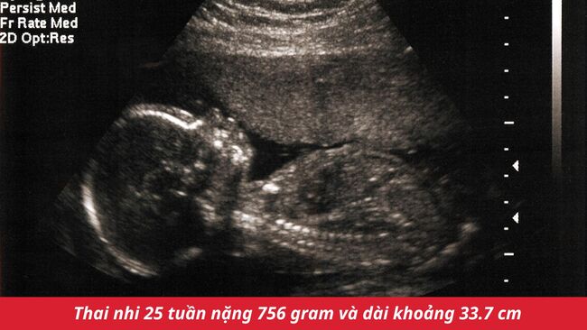 Thai nhi 25 tuần nặng 756 gram và dài khoảng 33.7 cm