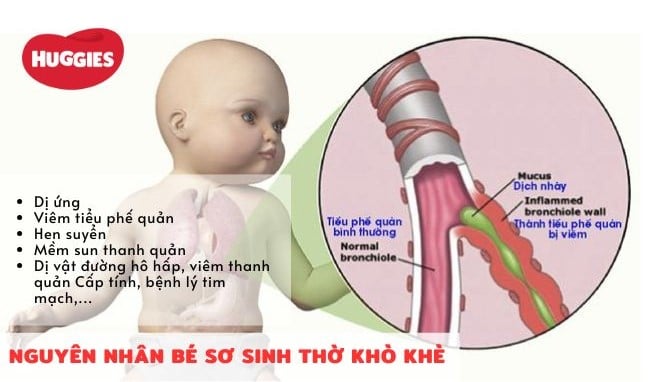 Các nguyên nhân gây thở khò khè ở trẻ sơ sinh