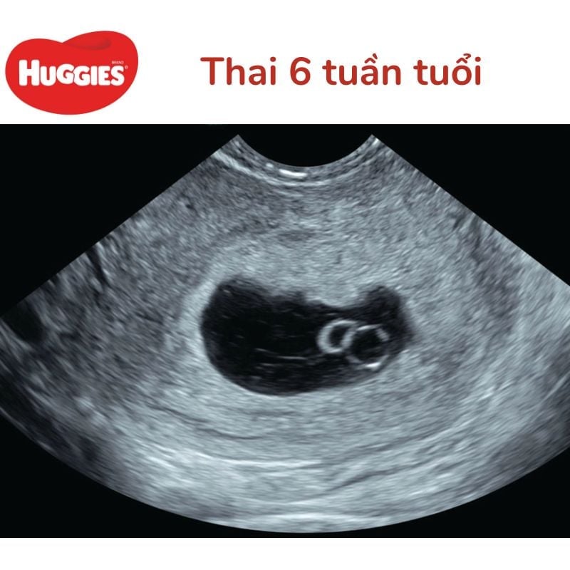 4. Chẩn đoán và xử trí sảy thai ở tuần thứ 6